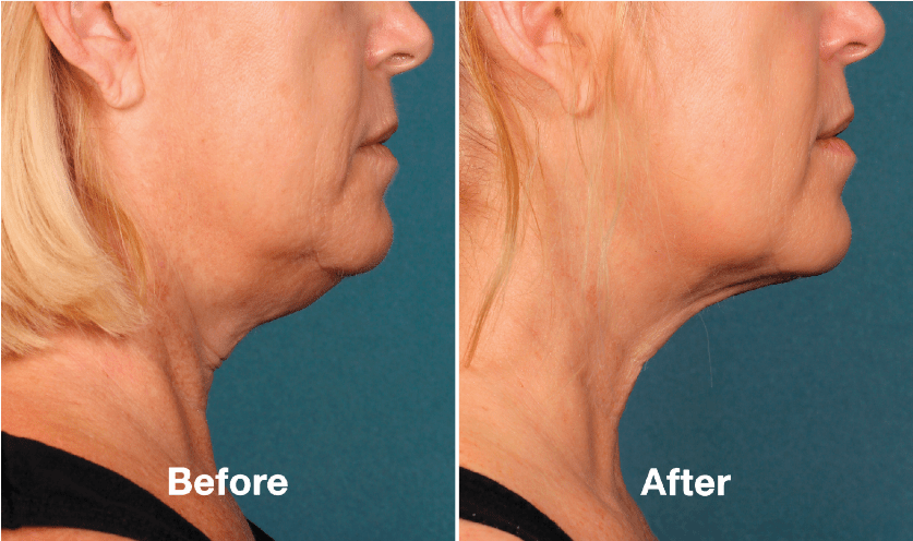 Is Kybella right for me?