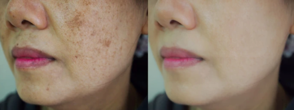 before & after brown_spots_gone Premier Med Spa at Richardson, TX