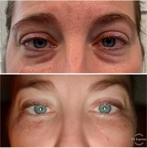 Reverse The Signs of Aging with Plasma Pen- Premier Med Spa