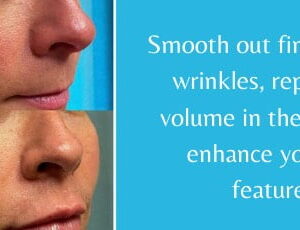 Filler Specials | before & after treatment images | Premier Medspa