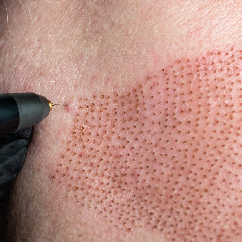 What You Need To Know About Plasma Pen