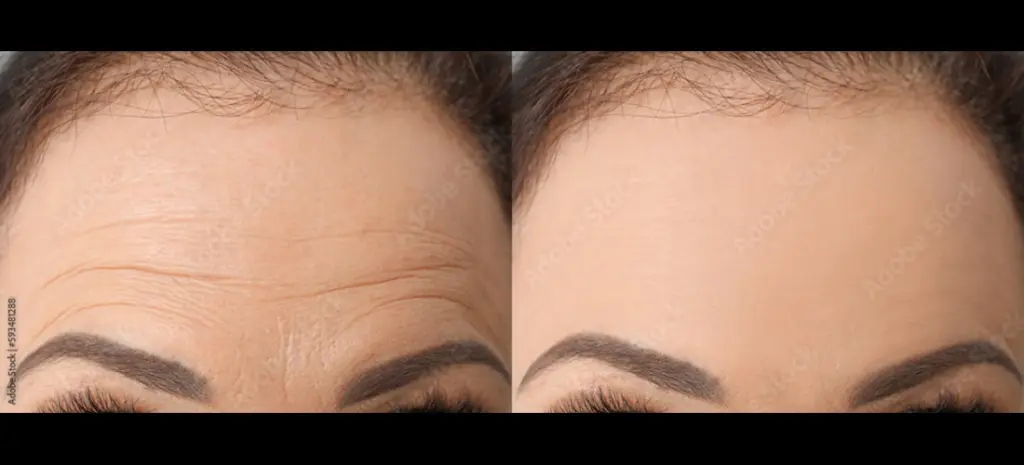 Botox and Dysport Treatment on Forehead | Premier Medspa in Texas