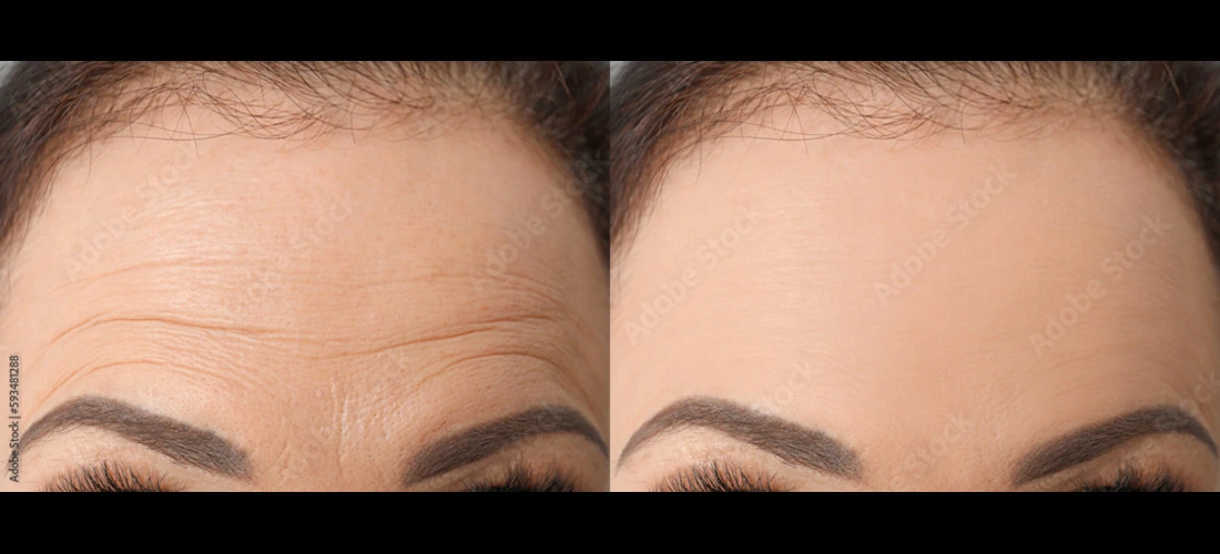 Botox and Dysport Treatment on Forehead | Premier Medspa in Texas